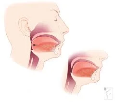 Obstructive Sleep Apnea)