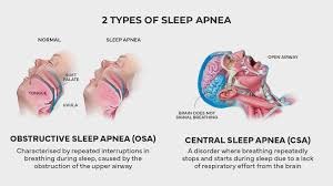 Sleep Apnea vs. OSA Are They the Same or Different?