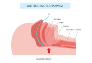 OSA vs OHS Key Differences Between Obstructive Sleep Apnea and Obesity Hypoventilation Syndrome